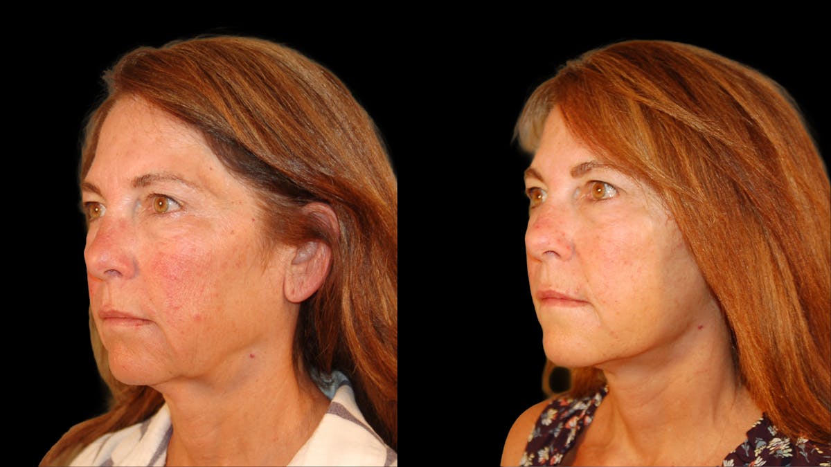 Deep Plane Facelift Before & After Gallery - Patient 222436 - Image 2
