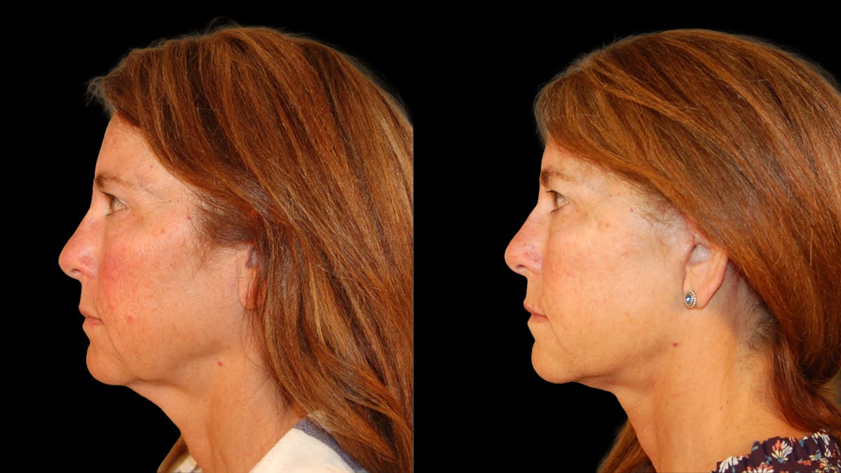 Deep Plane Facelift Before & After Gallery - Patient 222436 - Image 3