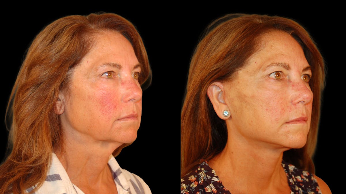 Deep Plane Facelift Before & After Gallery - Patient 222436 - Image 4