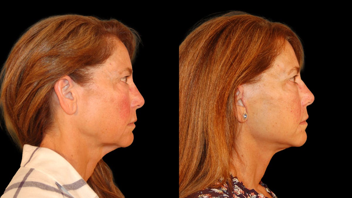 Deep Plane Facelift Before & After Gallery - Patient 222436 - Image 5