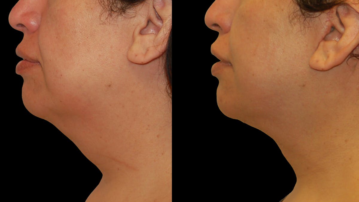 Deep Plane Facelift Before & After Gallery - Patient 869409 - Image 2