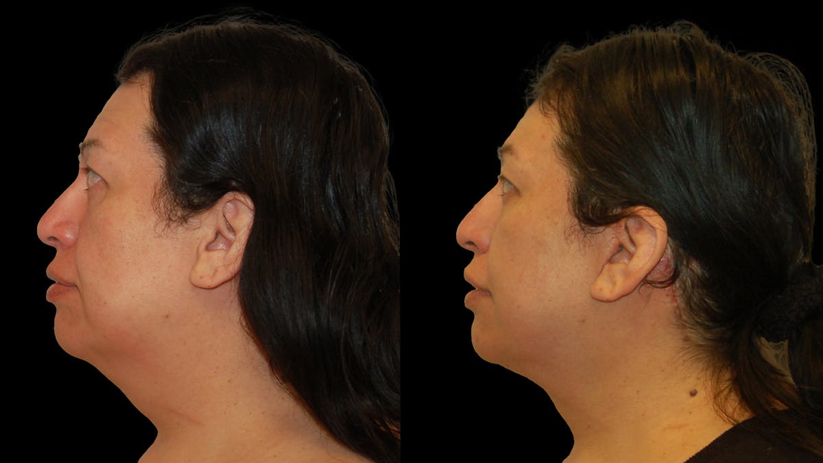 Deep Plane Facelift Before & After Gallery - Patient 869409 - Image 3