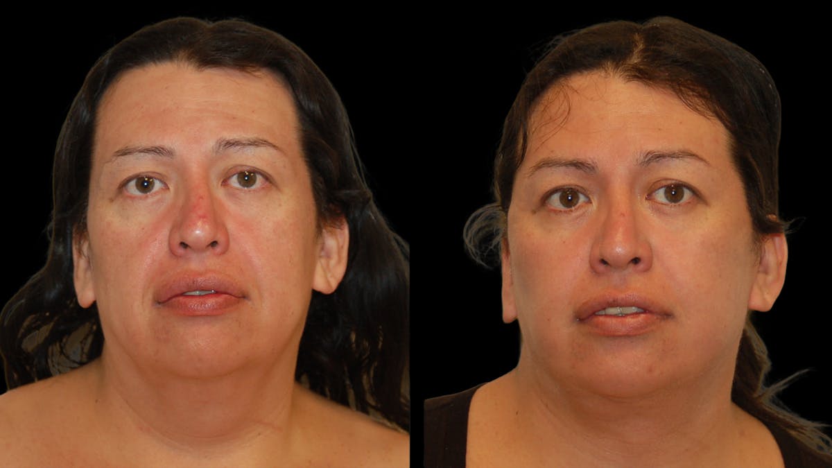 Deep Plane Facelift Before & After Gallery - Patient 869409 - Image 1
