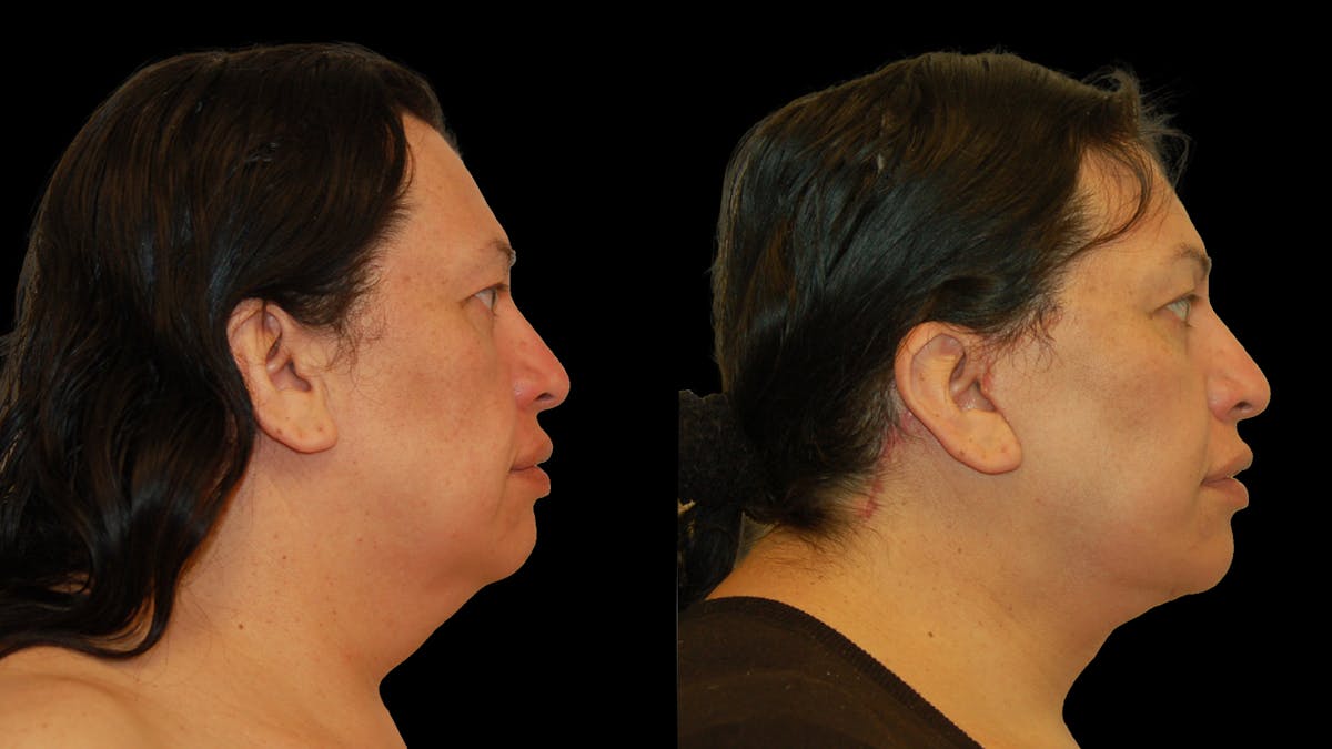 Deep Plane Facelift Before & After Gallery - Patient 869409 - Image 4