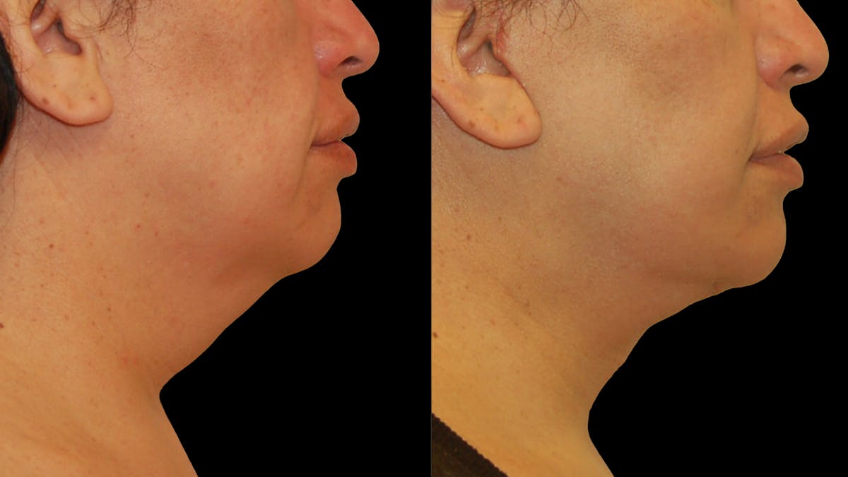 Deep Plane Facelift Before & After Gallery - Patient 869409 - Image 5