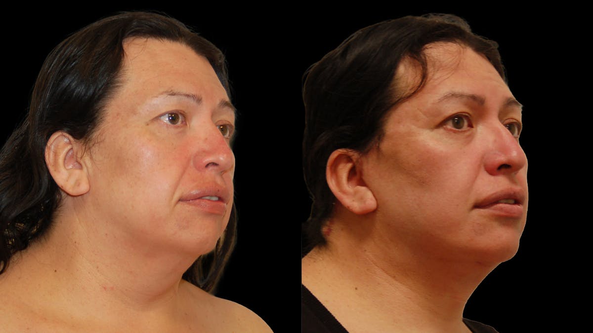 Deep Plane Facelift Before & After Gallery - Patient 869409 - Image 6