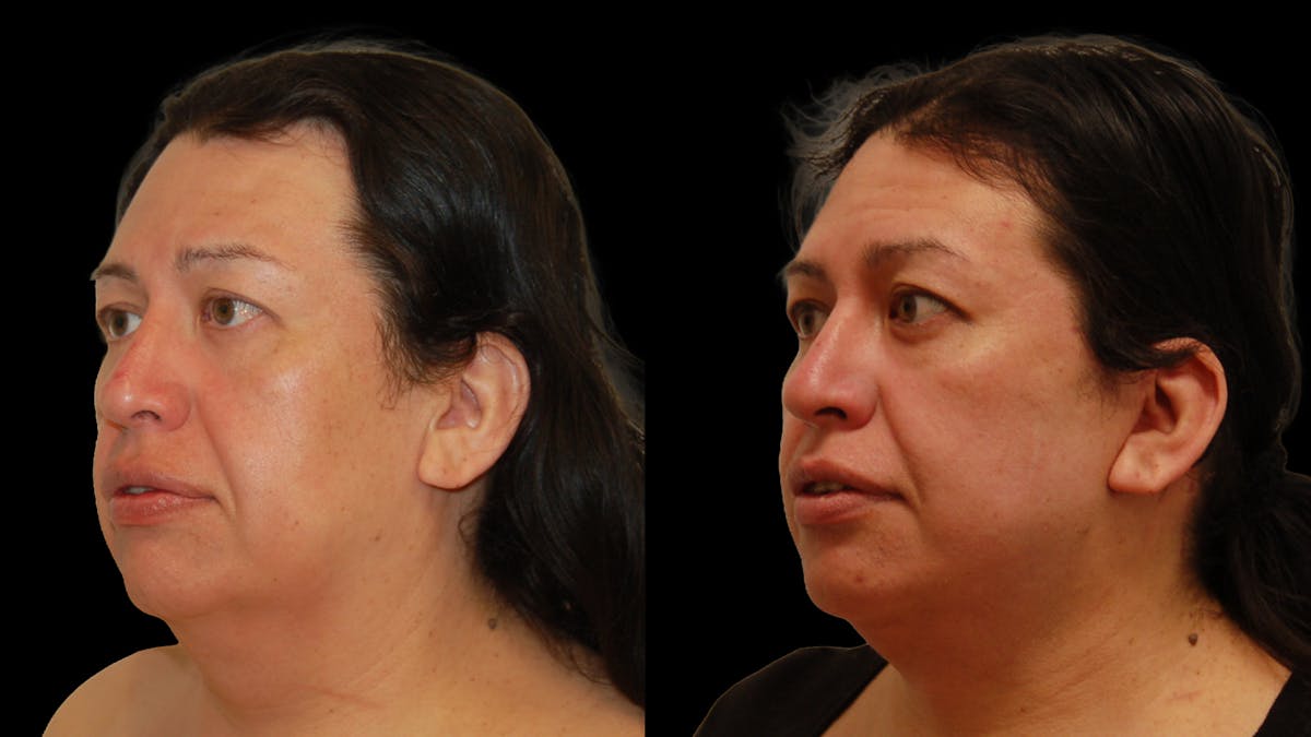 Deep Plane Facelift Before & After Gallery - Patient 869409 - Image 7