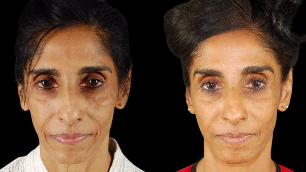 Facial Fat Grafting Before & After Gallery - Patient 256796 - Image 1