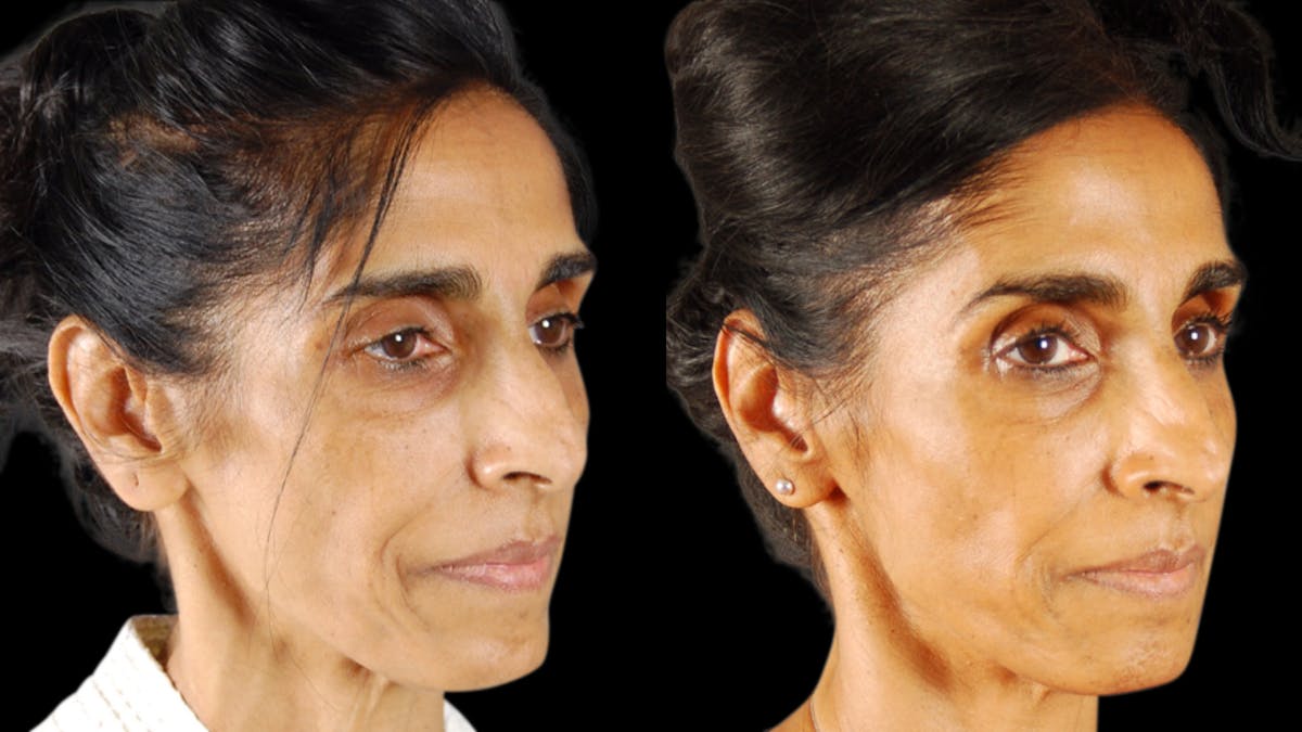 Facial Fat Grafting Before & After Gallery - Patient 256796 - Image 2