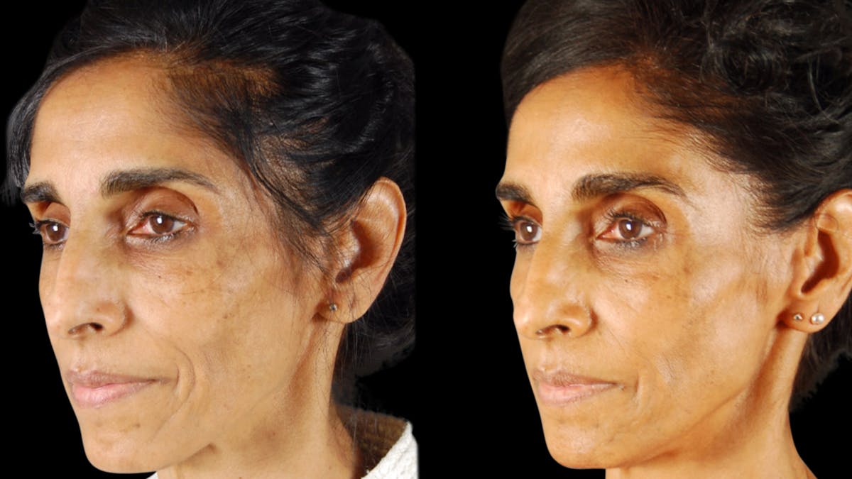 Facial Fat Grafting Before & After Gallery - Patient 256796 - Image 3