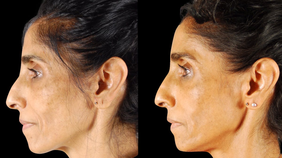 Facial Fat Grafting Before & After Gallery - Patient 256796 - Image 4