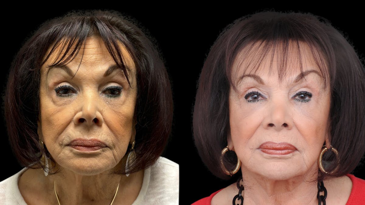 Facial Fat Grafting Before & After Gallery - Patient 382964 - Image 1