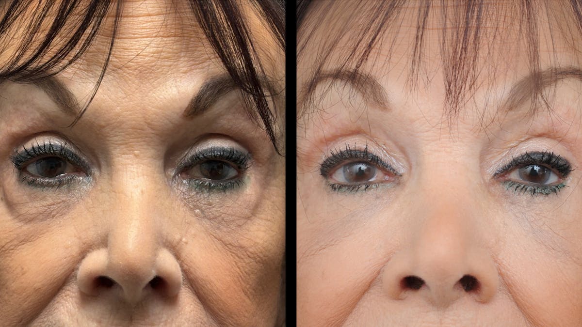 Facial Fat Grafting Before & After Gallery - Patient 382964 - Image 2