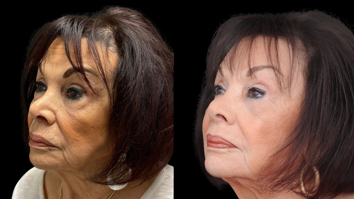 Facial Fat Grafting Before & After Gallery - Patient 382964 - Image 3