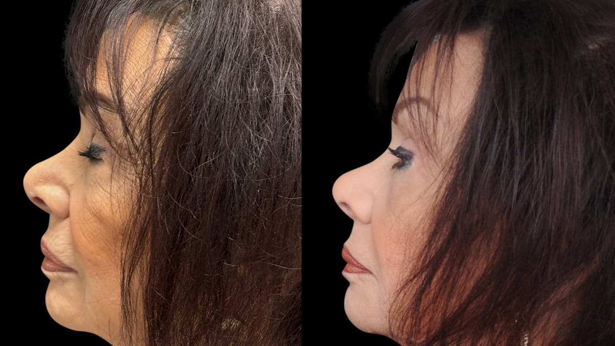 Facial Fat Grafting Before & After Gallery - Patient 382964 - Image 5