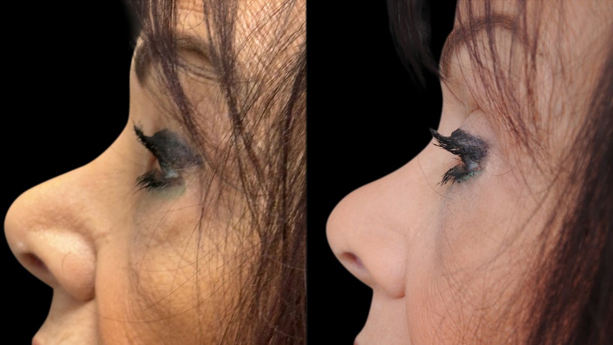 Facial Fat Grafting Before & After Gallery - Patient 382964 - Image 6