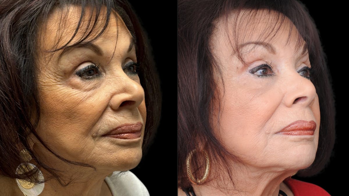 Facial Fat Grafting Before & After Gallery - Patient 382964 - Image 7
