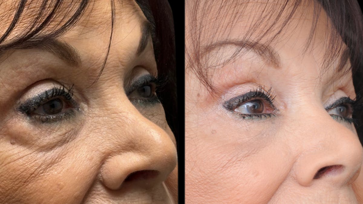 Facial Fat Grafting Before & After Gallery - Patient 382964 - Image 8