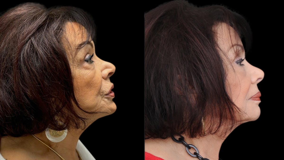 Facial Fat Grafting Before & After Gallery - Patient 382964 - Image 9