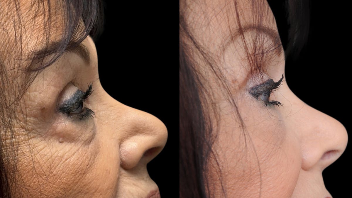 Facial Fat Grafting Before & After Gallery - Patient 382964 - Image 10