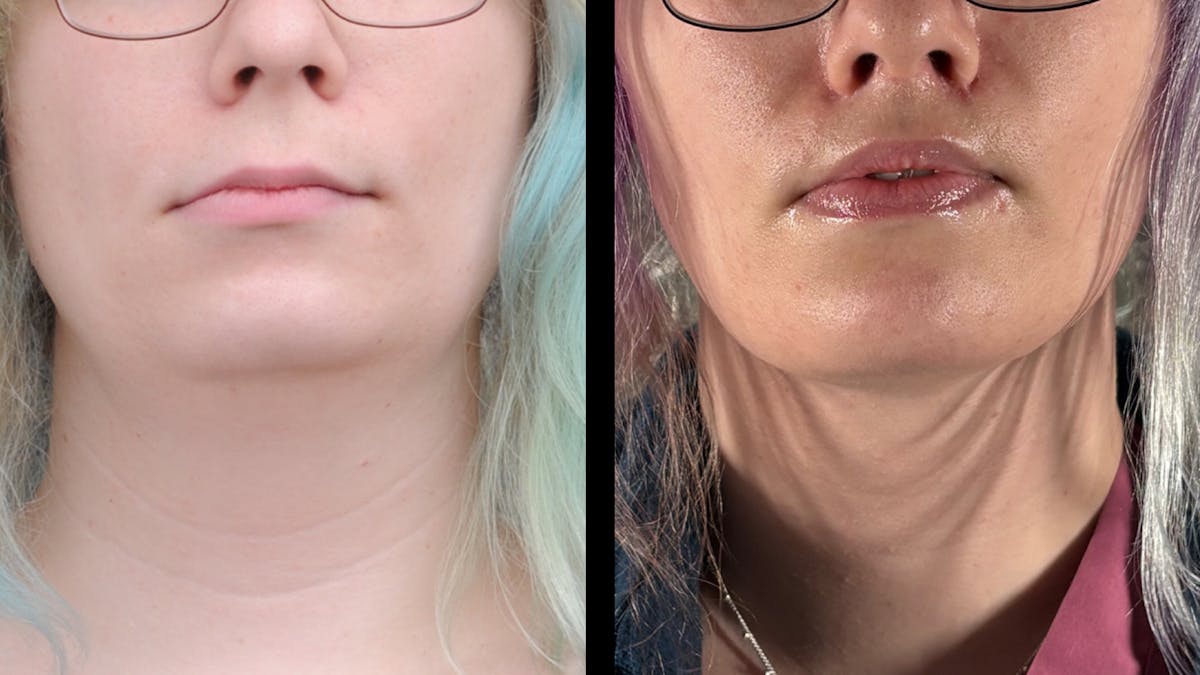 Facial Feminization Before & After Gallery - Patient 184029 - Image 3