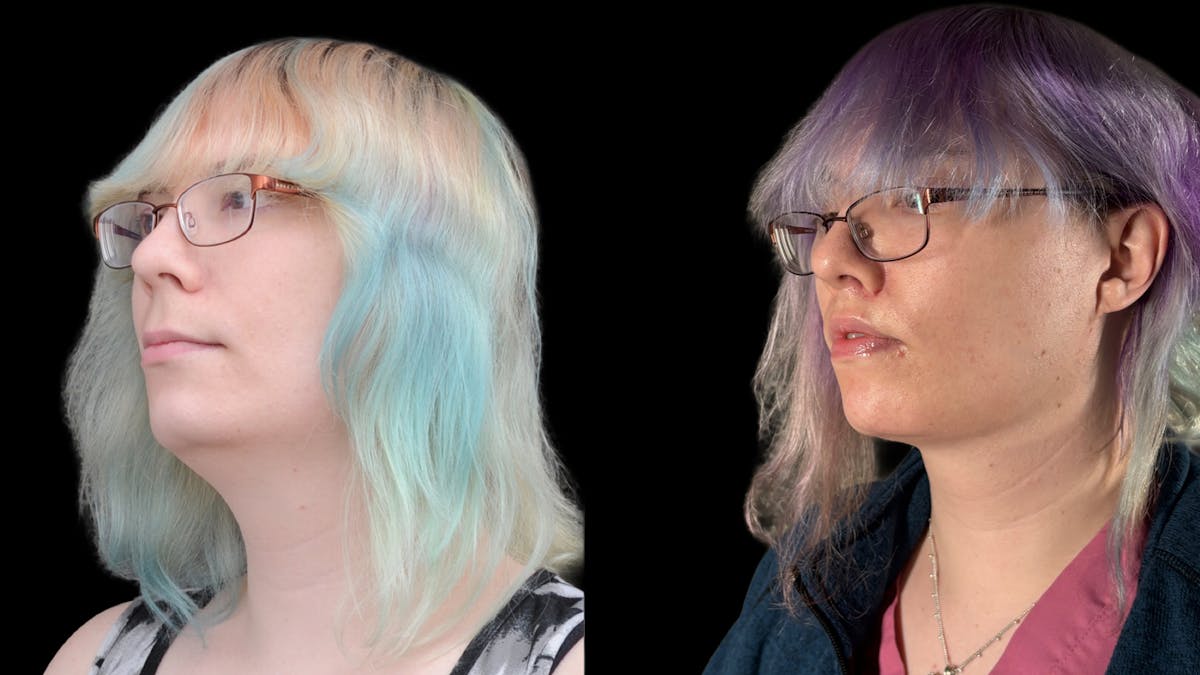 Facial Feminization Before & After Gallery - Patient 184029 - Image 4