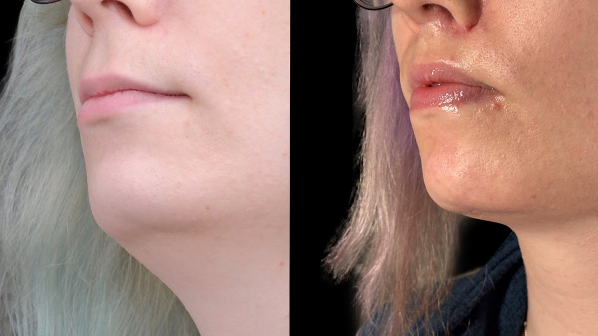 Facial Feminization Before & After Gallery - Patient 184029 - Image 5