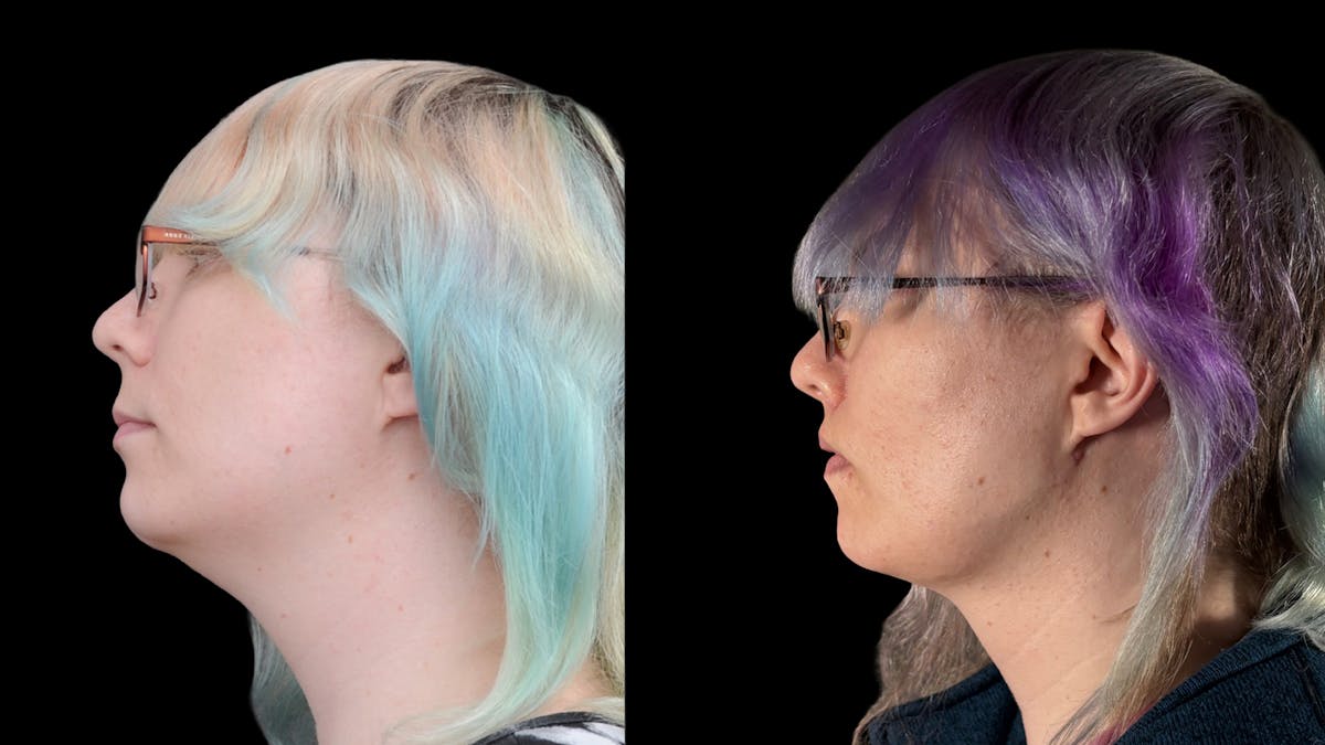 Facial Feminization Before & After Gallery - Patient 184029 - Image 6