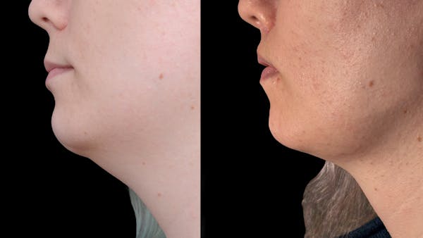 Facial Feminization Before & After Gallery - Patient 184029 - Image 1