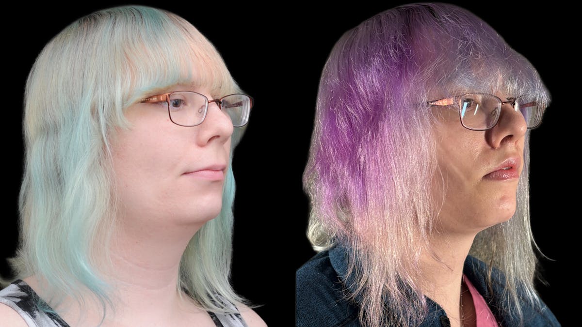 Facial Feminization Before & After Gallery - Patient 184029 - Image 7