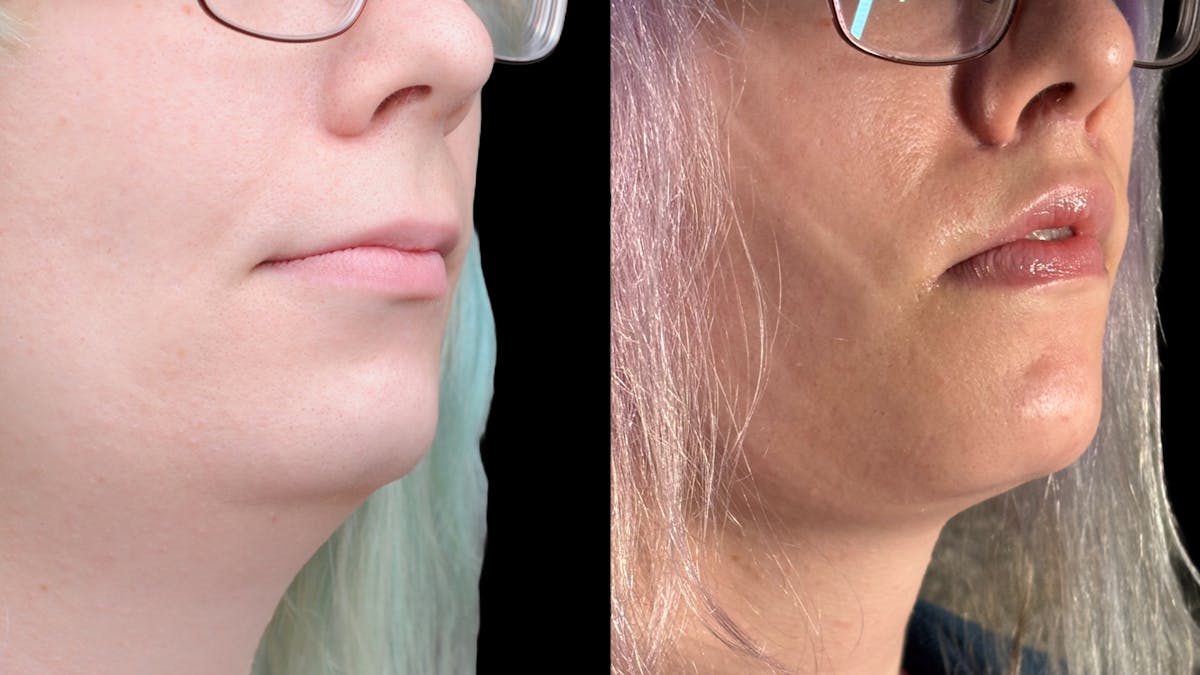 Facial Feminization Before & After Gallery - Patient 184029 - Image 8