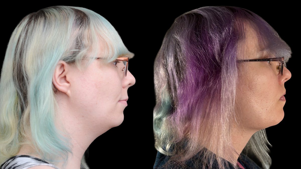 Facial Feminization Before & After Gallery - Patient 184029 - Image 9