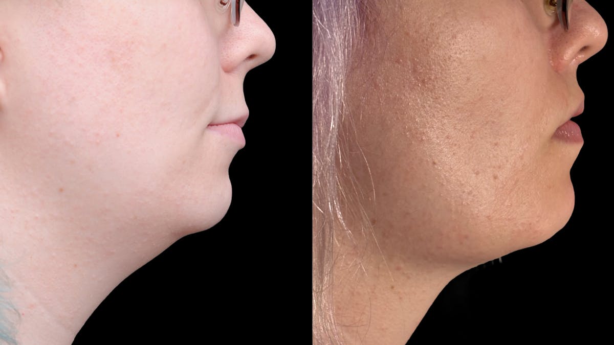 Facial Feminization Before & After Gallery - Patient 184029 - Image 10