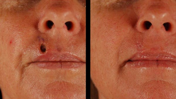 Facial Reconstruction Before & After Gallery - Patient 370691 - Image 1
