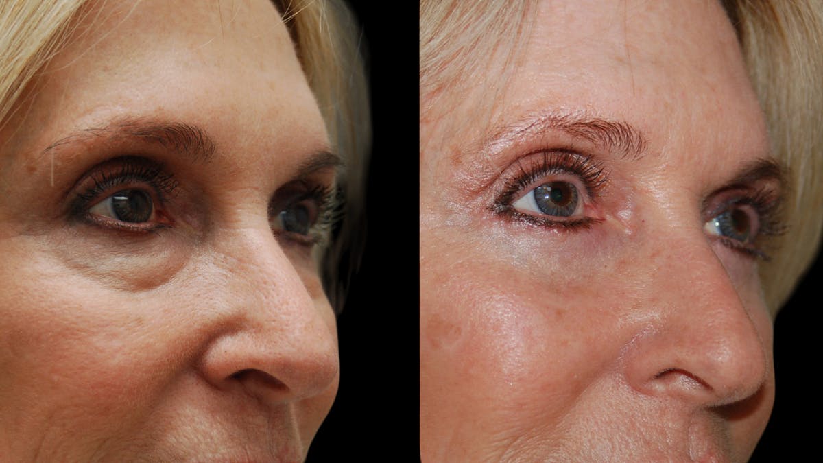 Lower Eyelid Surgery Before & After Gallery - Patient 192236 - Image 6