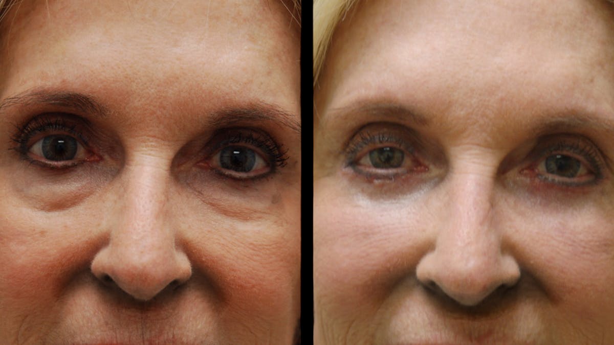 Lower Eyelid Surgery Before & After Gallery - Patient 192236 - Image 7