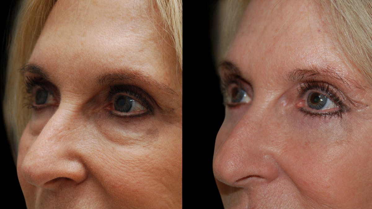 Lower Eyelid Surgery Before & After Gallery - Patient 192236 - Image 8