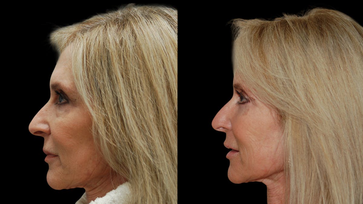 Lower Eyelid Surgery Before & After Gallery - Patient 192236 - Image 3