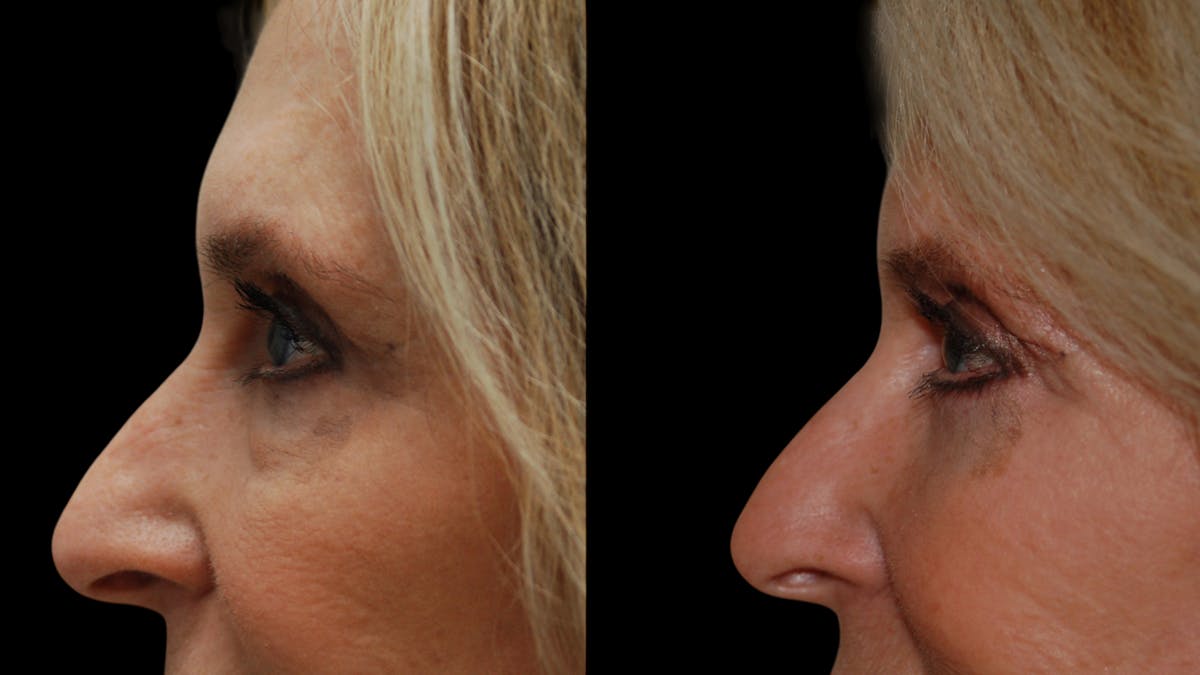Lower Eyelid Surgery Before & After Gallery - Patient 192236 - Image 9