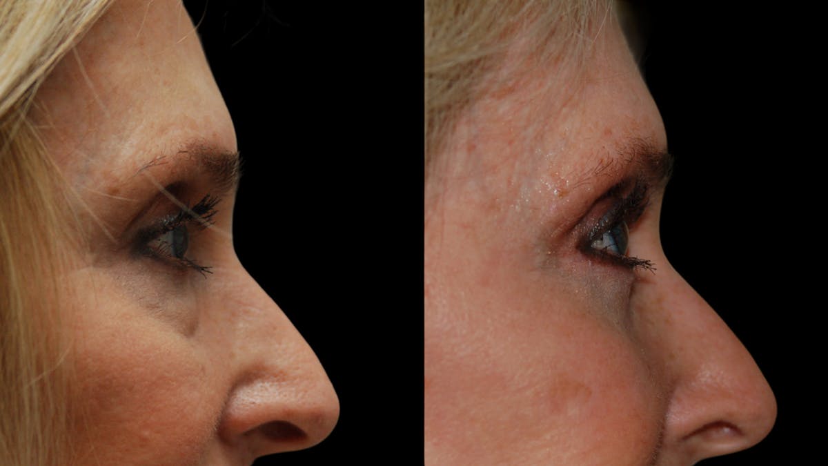 Lower Eyelid Surgery Before & After Gallery - Patient 192236 - Image 10