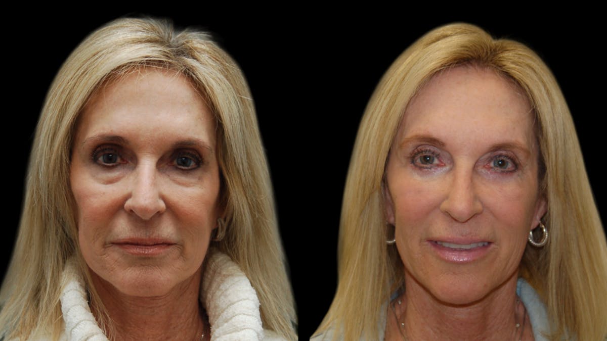 Lower Eyelid Surgery Before & After Gallery - Patient 192236 - Image 2