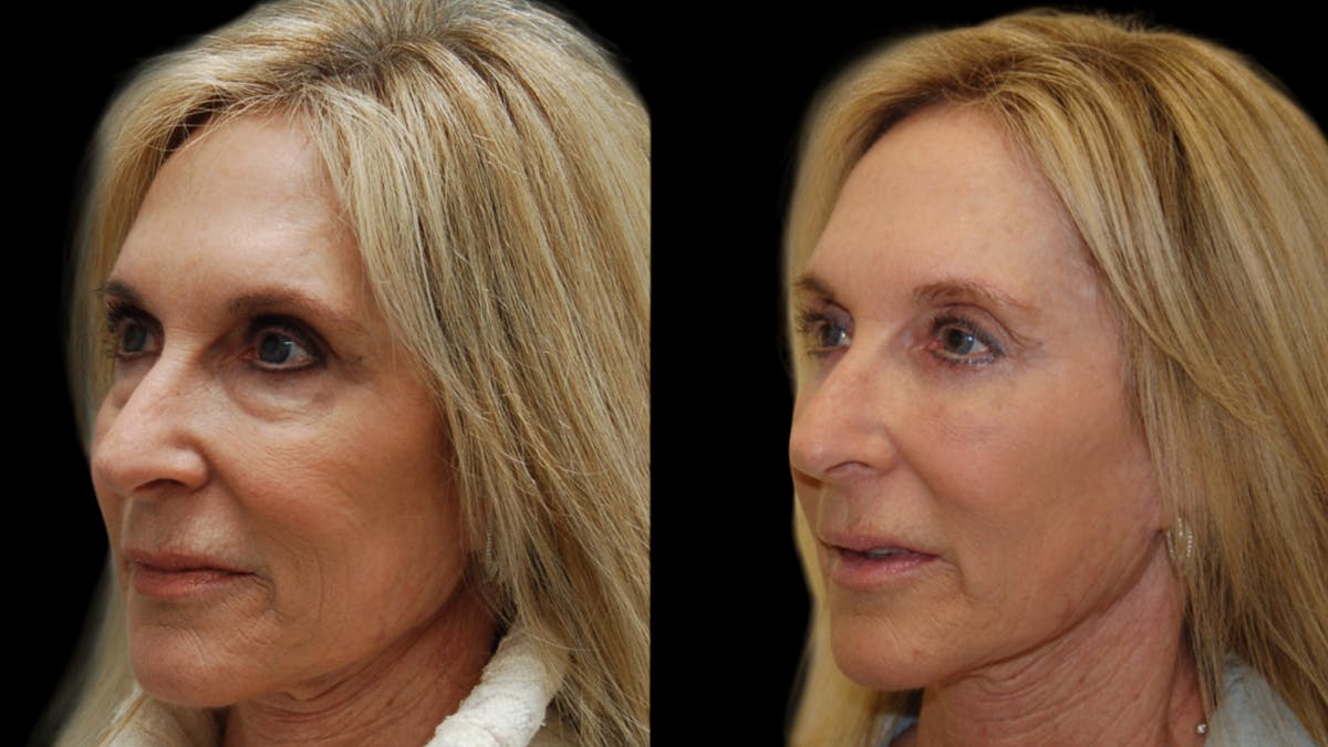 Lower Eyelid Surgery Before & After Gallery - Patient 192236 - Image 1