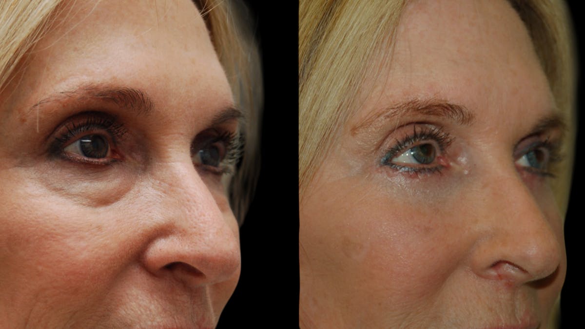 Lower Eyelid Surgery Before & After Gallery - Patient 192236 - Image 11