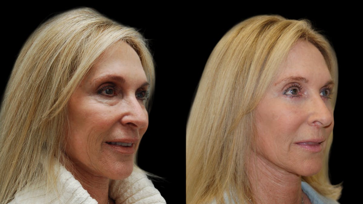 Lower Eyelid Surgery Before & After Gallery - Patient 192236 - Image 4