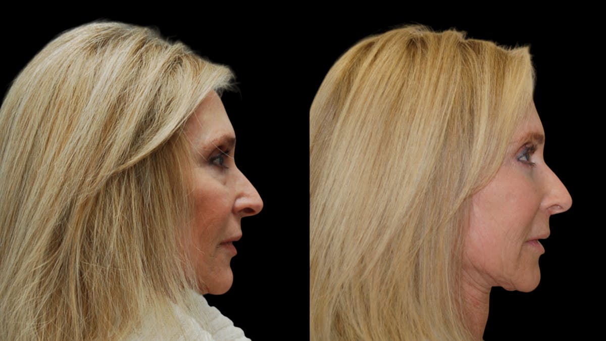 Lower Eyelid Surgery Before & After Gallery - Patient 192236 - Image 5