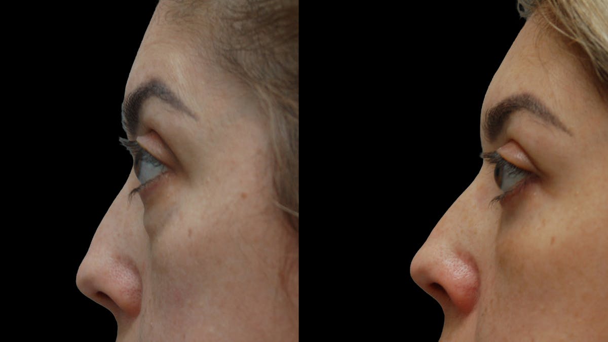 Lower Eyelid Surgery Before & After Gallery - Patient 266143 - Image 7