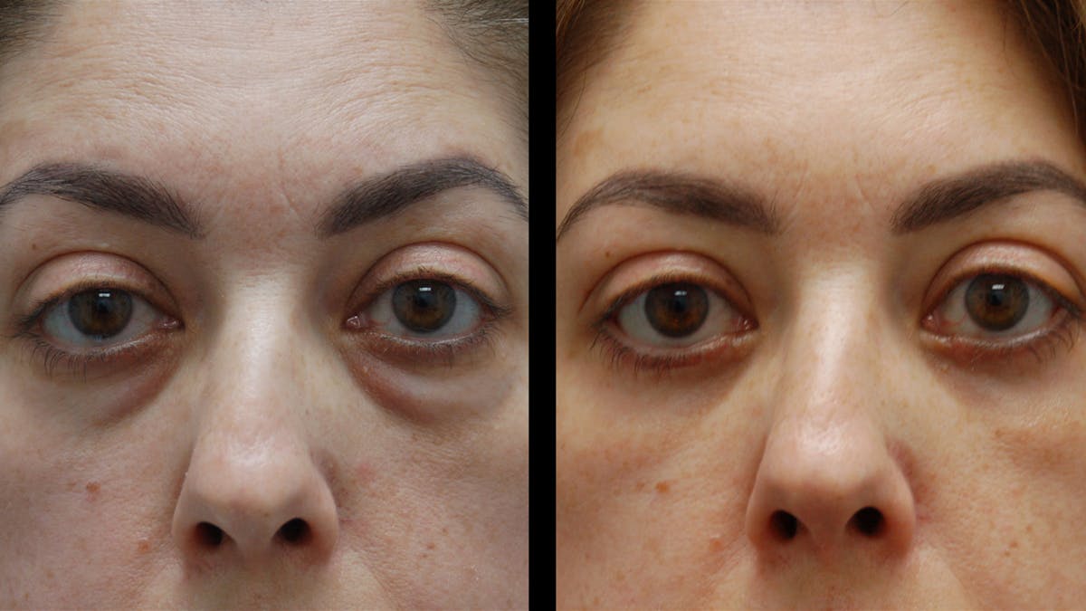 Lower Eyelid Surgery Before & After Gallery - Patient 266143 - Image 8