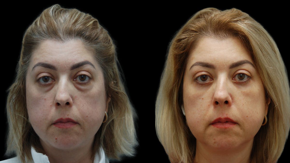 Lower Eyelid Surgery Before & After Gallery - Patient 266143 - Image 2