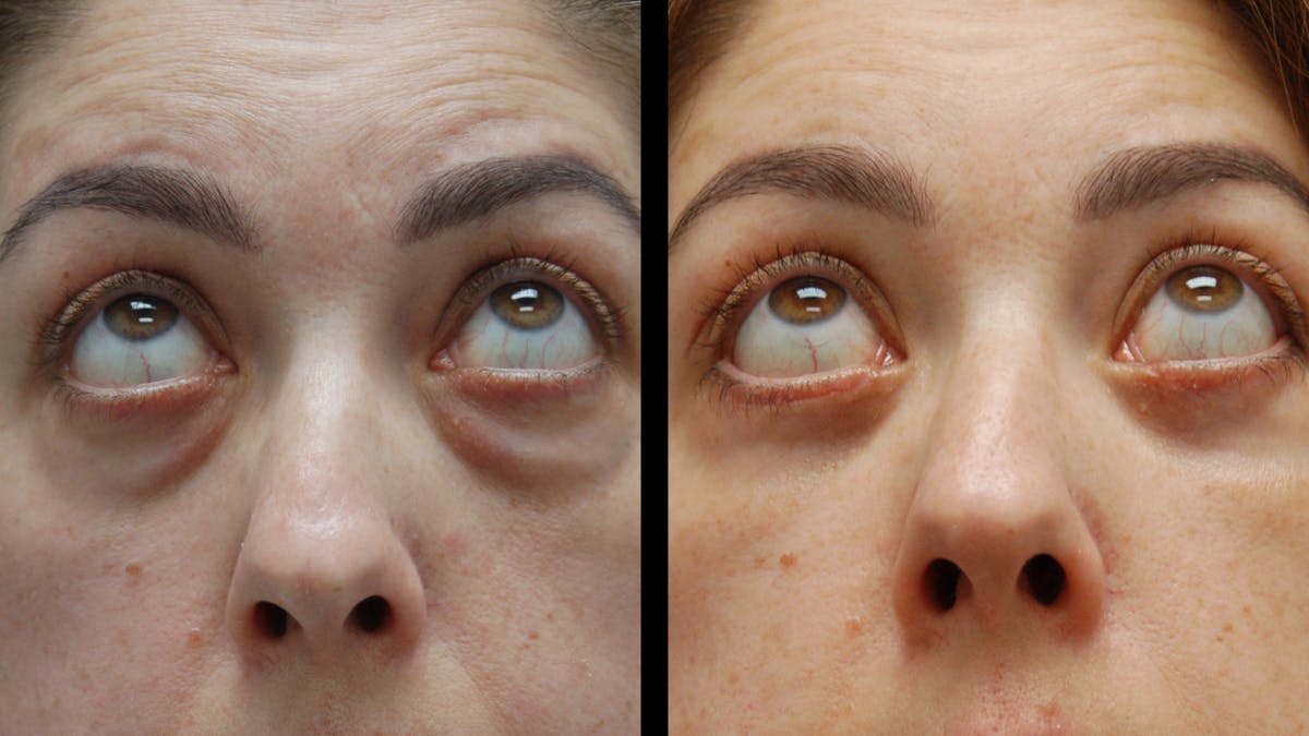 Lower Eyelid Surgery Before & After Gallery - Patient 266143 - Image 9
