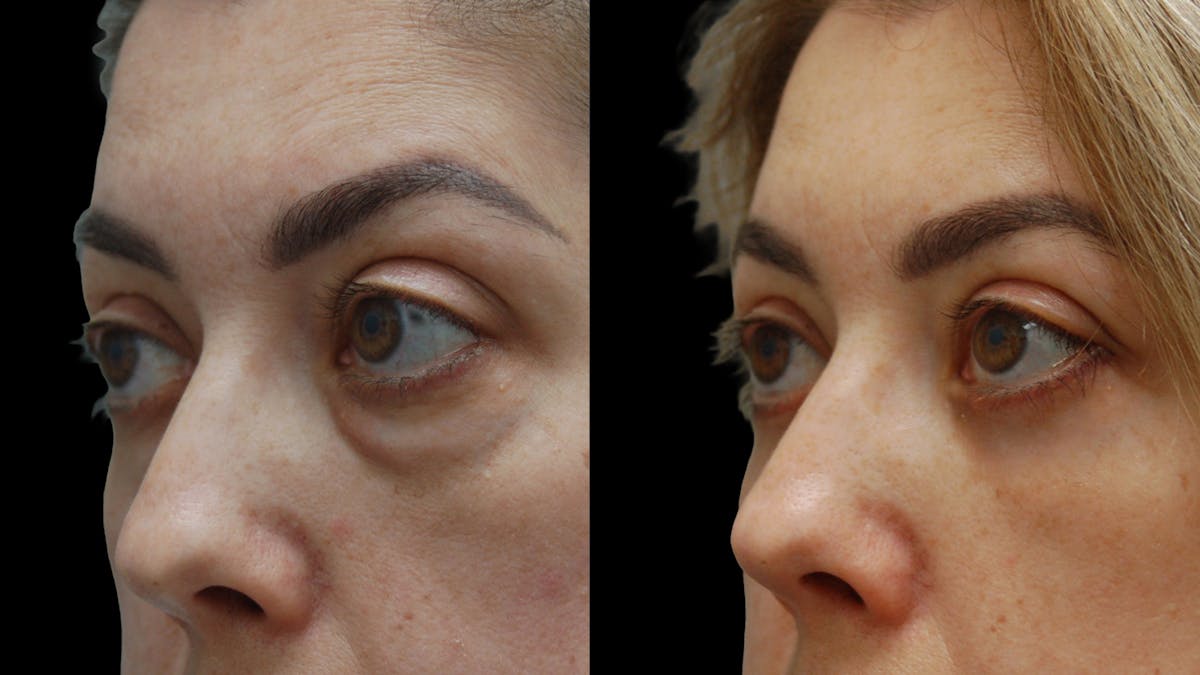 Lower Eyelid Surgery Before & After Gallery - Patient 266143 - Image 10
